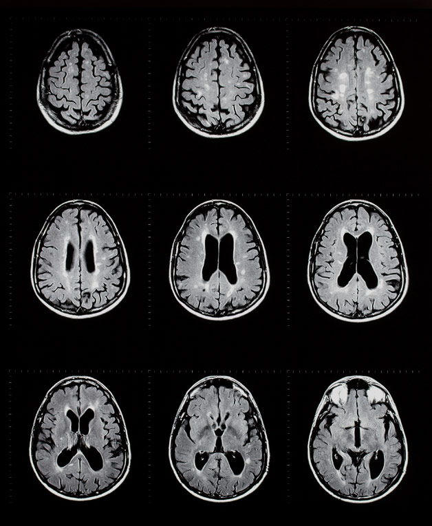 MRI-Scans