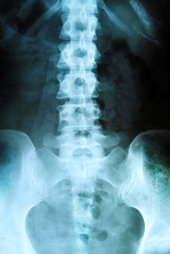 Spinal-X-ray